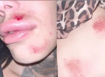 transragazze Castiglione in Teverina, aggredite e picchiate due ragazze trans